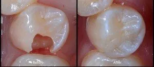 Fillings and Sealants